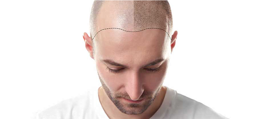 Hair Transplant